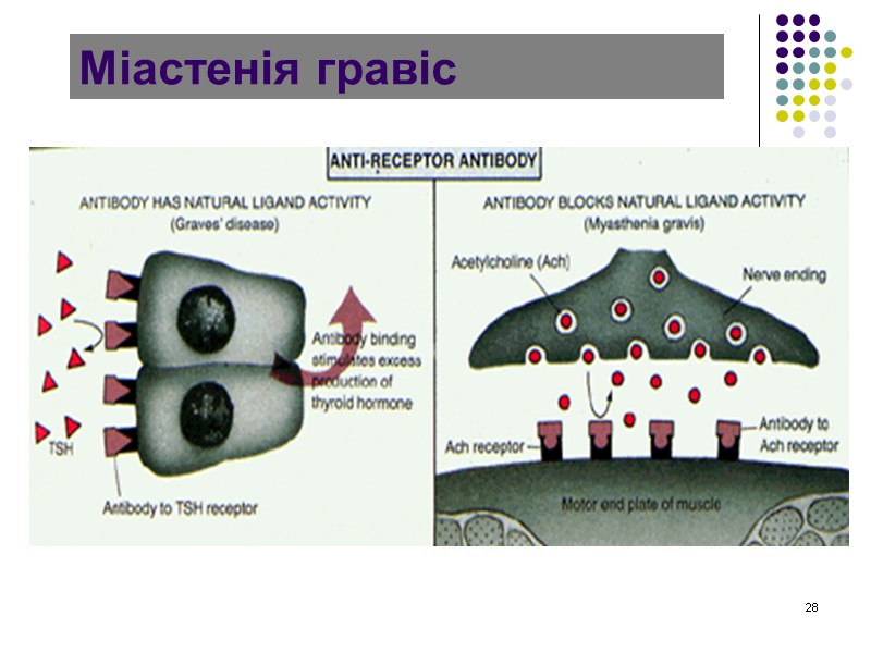 28 Міастенія гравіс